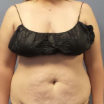 Abdominoplasty Before & After Patient #5197