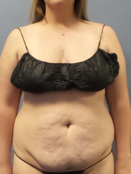 Abdominoplasty Before & After Patient #5197