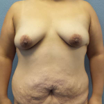 Abdominoplasty Before & After Patient #3735