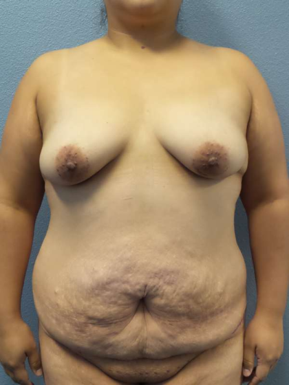 Abdominoplasty Before & After Patient #3735