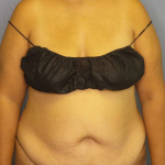 Abdominoplasty Before & After Patient #3638