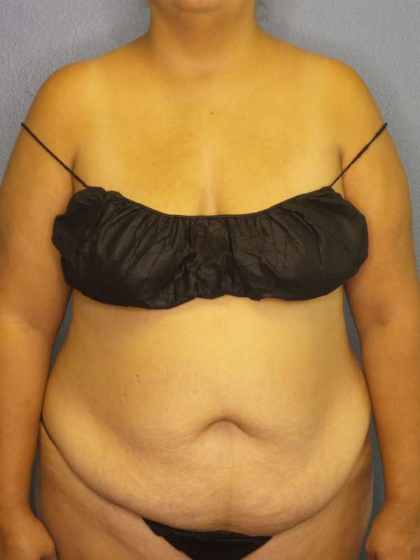 Abdominoplasty Before & After Patient #3638