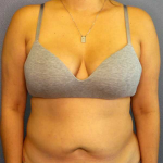 Abdominoplasty Before & After Patient #3583