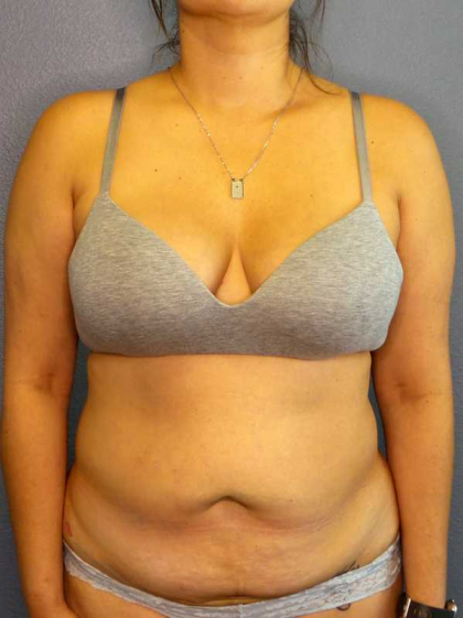 Abdominoplasty Before & After Patient #3583