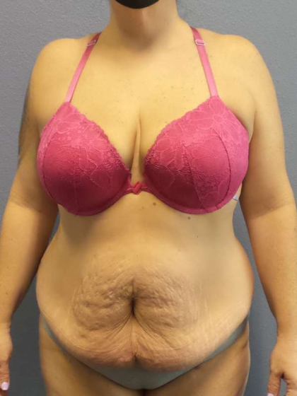 Abdominoplasty Before & After Patient #3572