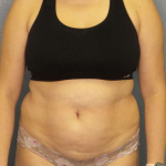 Liposuction Female Before & After Patient #7966