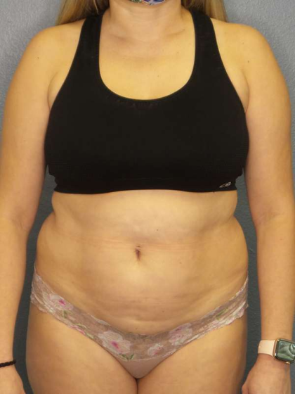 Liposuction Female Before & After Patient #7966