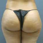 Brazilian Butt Lift Before & After Patient #4903