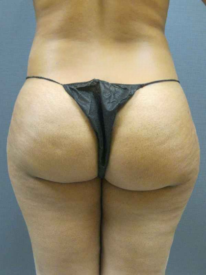 Brazilian Butt Lift Before & After Patient #4903