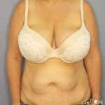 Abdominoplasty Before & After Patient #3786