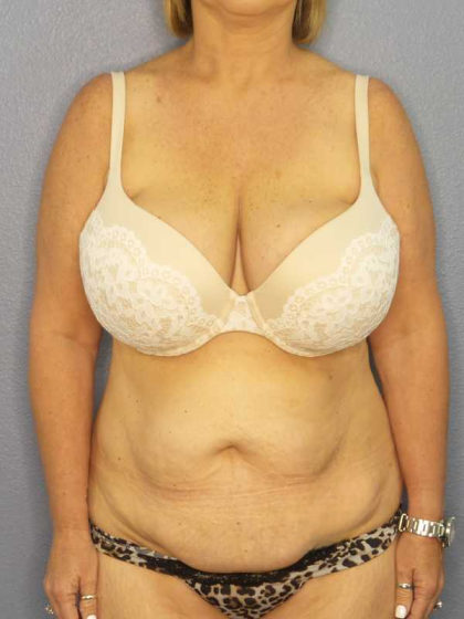 Abdominoplasty Before & After Patient #3786