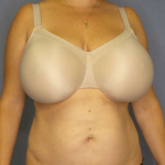 Liposuction Female Before & After Patient #8123