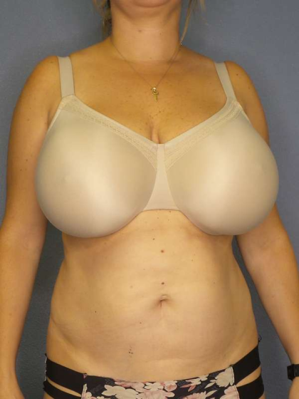 Liposuction Female Before & After Patient #8123