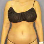 Liposuction Female Before & After Patient #8058