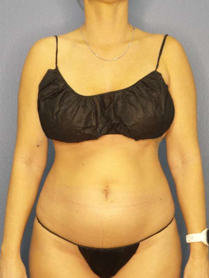 Liposuction Female Before & After Patient #8058