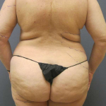 Liposuction Female Before & After Patient #7866