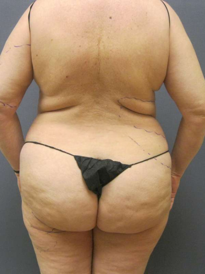 Liposuction Female Before & After Patient #7866