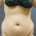 Liposuction Female Before & After Patient #7776