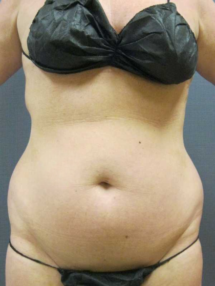 Liposuction Female Before & After Patient #7776