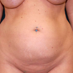 Liposuction Female Before & After Patient #7692