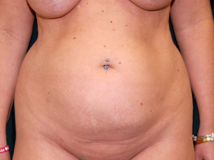 Liposuction Female Before & After Patient #7692