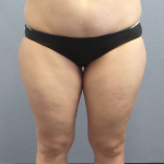 Liposuction Female Before & After Patient #7709