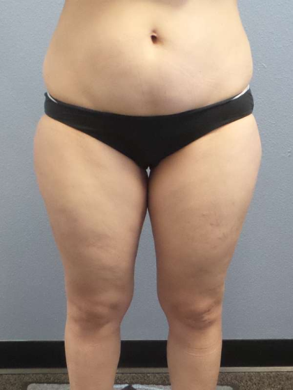Liposuction Female Before & After Patient #7709