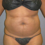 Liposuction Female Before & After Patient #7668