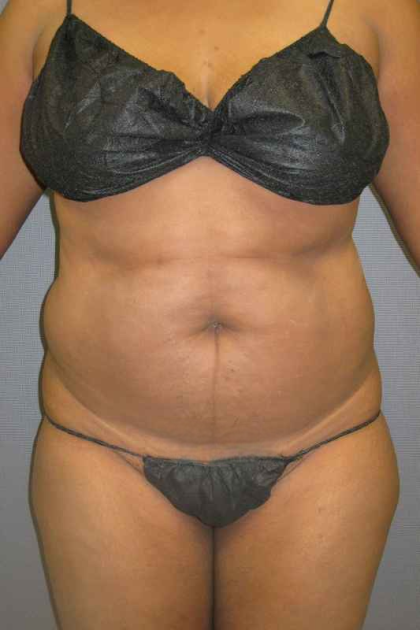 Liposuction Female Before & After Patient #7668