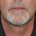Liposuction of the Neck Before & After Patient #12042