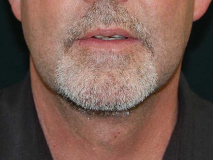 Liposuction of the Neck Before & After Patient #12042