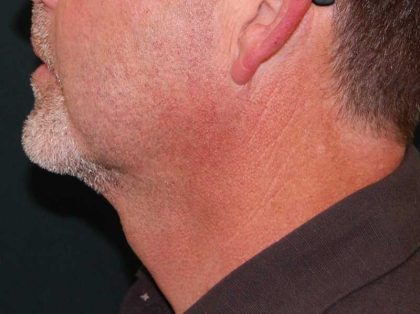 Liposuction of the Neck Before & After Patient #12042