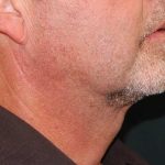 Liposuction of the Neck Before & After Patient #12042