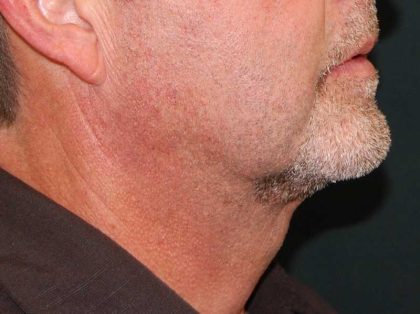 Liposuction of the Neck Before & After Patient #12042