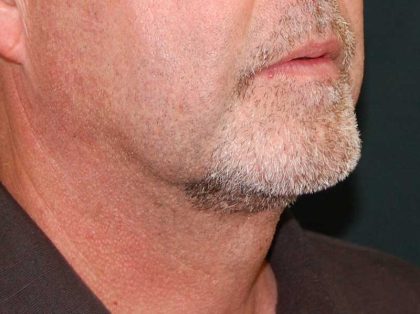 Liposuction of the Neck Before & After Patient #12042