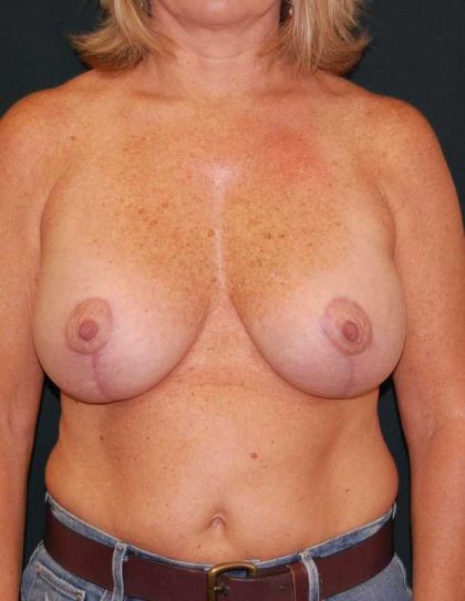 Breast Lift with Implant (Augmentation Mastopexy) Before & After Patient #11217