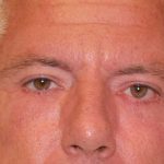 Otoplasty Before & After Patient #12292
