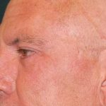 Otoplasty Before & After Patient #12292