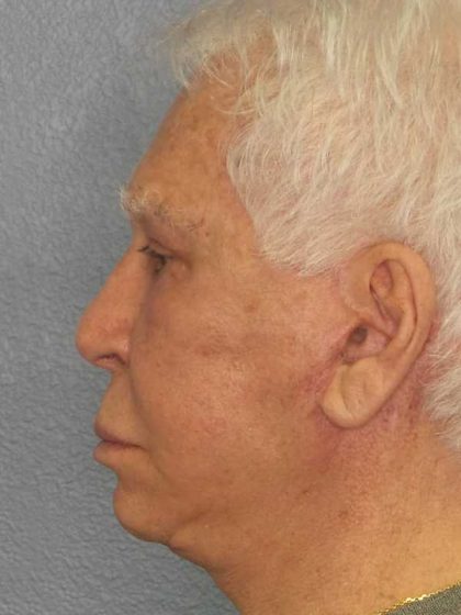 Facelift Before & After Patient #11809