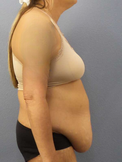 Abdominoplasty Before & After Patient #3594