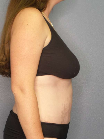 Abdominoplasty Before & After Patient #3409