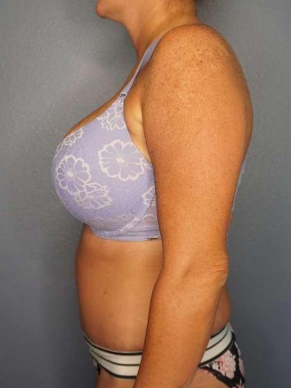 Abdominoplasty Before & After Patient #3272