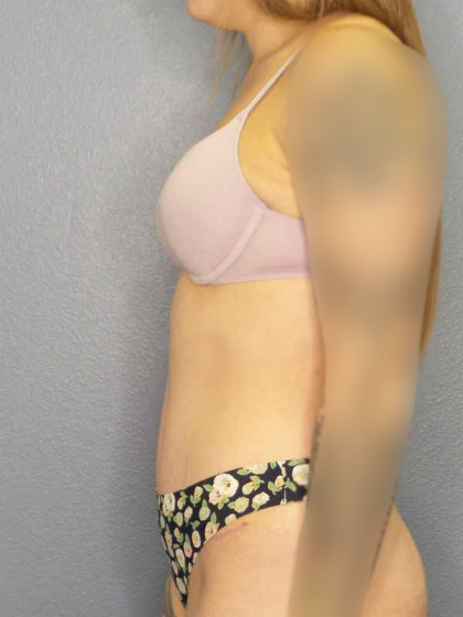 Abdominoplasty Before & After Patient #3236