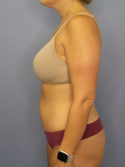 Abdominoplasty Before & After Patient #3225