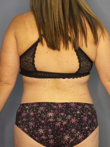 Liposuction Female Before & After Patient #11950
