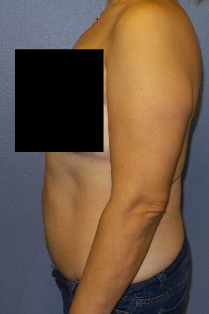 Abdominoplasty Before & After Patient #11131