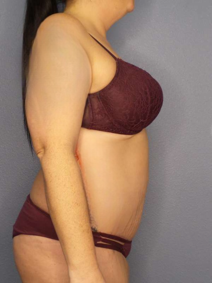 High BMI (Larger Patients) Surgery Before & After Patient #10378
