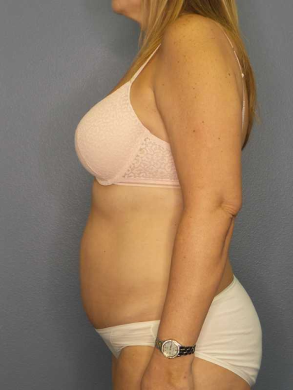 High BMI (Larger Patients) Surgery Before & After Patient #10329
