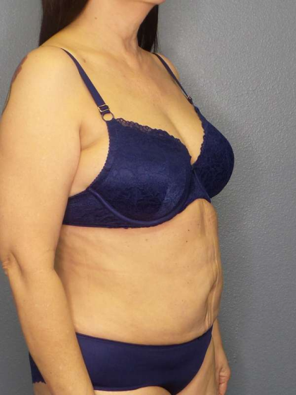 Liposuction Female Before & After Patient #7932