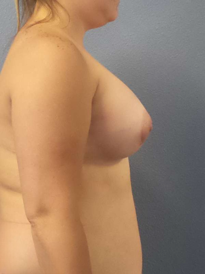 High BMI (Larger Patients) Surgery Before & After Patient #6042